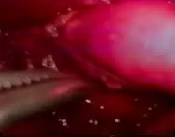 Timectomía Toracoscópica Pediátrica en Perú