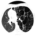 Lobectomía Pulmonar Uniportal